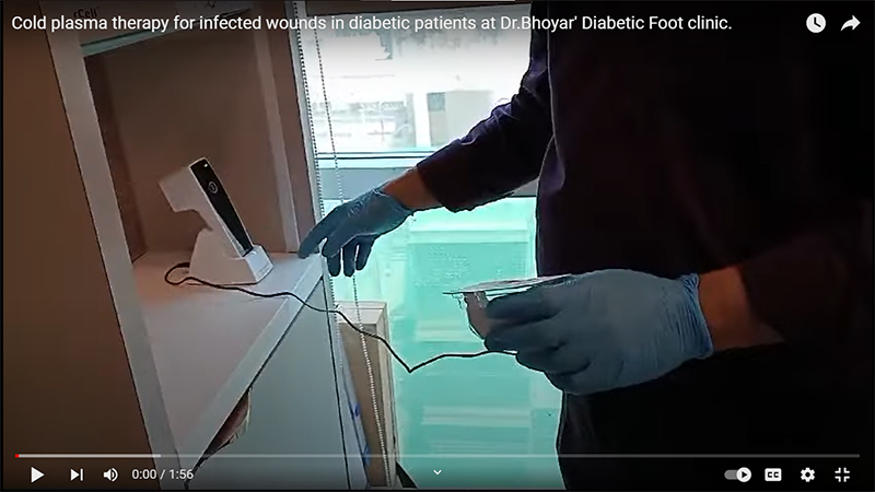 Diabetic Foot Management by Dr Shrikant Bhoyar , Diabetic Foot Surgeon 55 cases