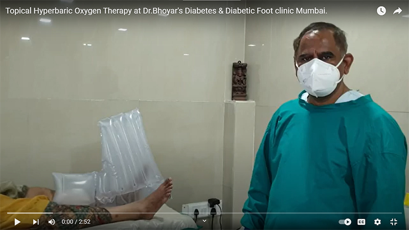 Diabetic Foot Management by Dr Shrikant Bhoyar , Diabetic Foot Surgeon 55 cases