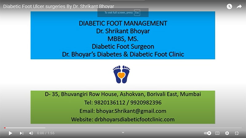 Diabetic Foot Management by Dr Shrikant Bhoyar , Diabetic Foot Surgeon 55 cases