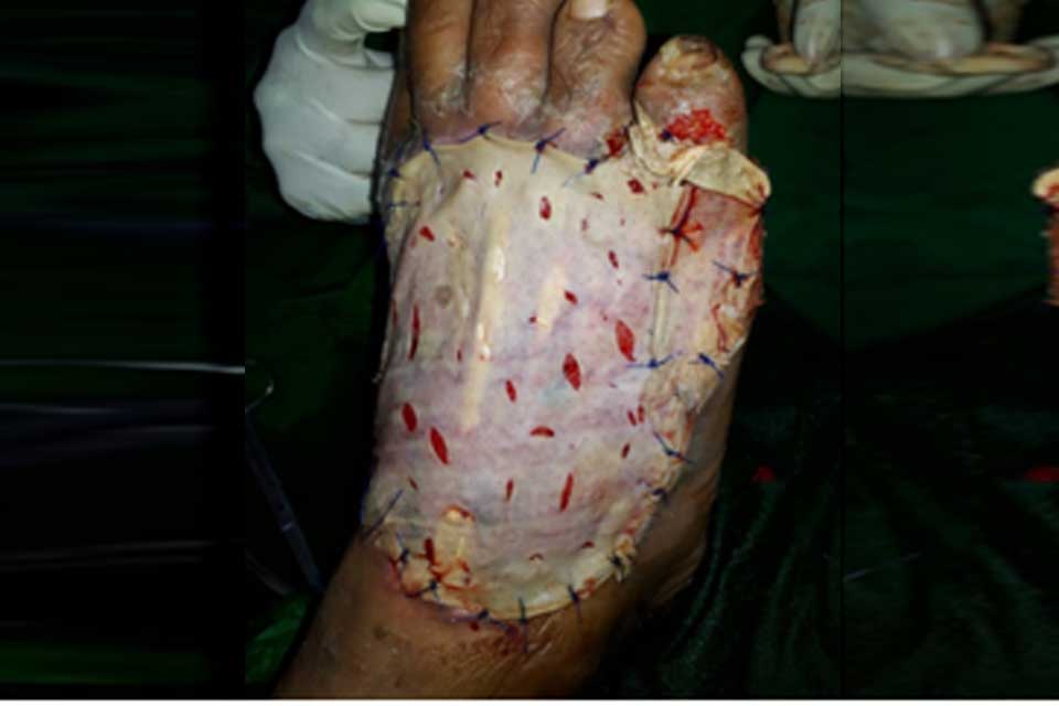 Skin Grafting & Plastic Surgeries: