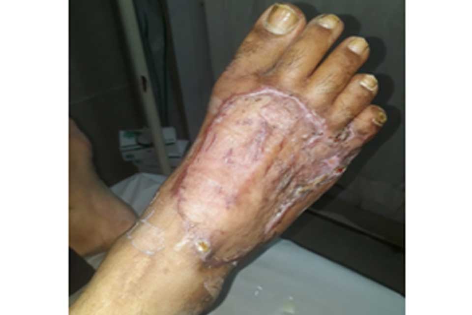 Skin Grafting & Plastic Surgeries: